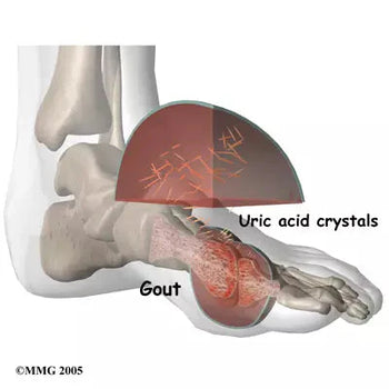 gout in the ankle