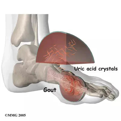 gout in the ankle